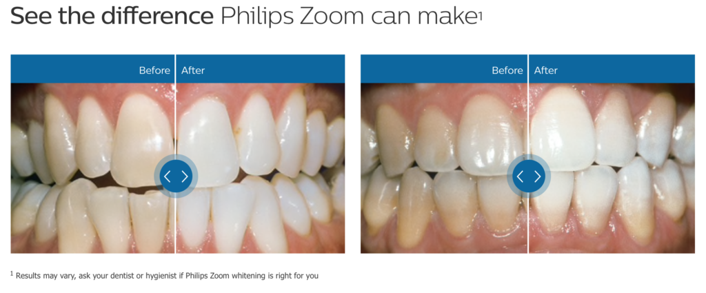 Introducing Philips Zoom Whitening McFarlane Family Dental